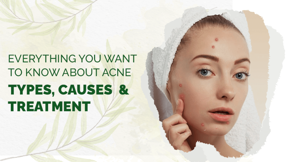 Acne: Types, Causes & Treatment | Everything You Want to Know About Acne